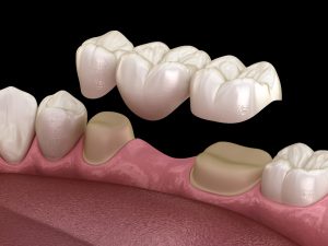 Dental Bridges in Port Coquitlam