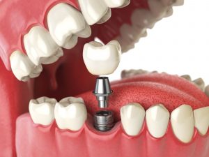 Dental Implants in Port Coquitlam
