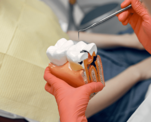 Root Canal Treatment