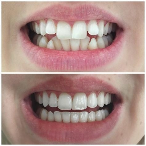 invisalign before and after