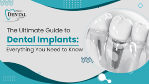 The Ultimate Guide to Dental Implants: Everything You Need to Know