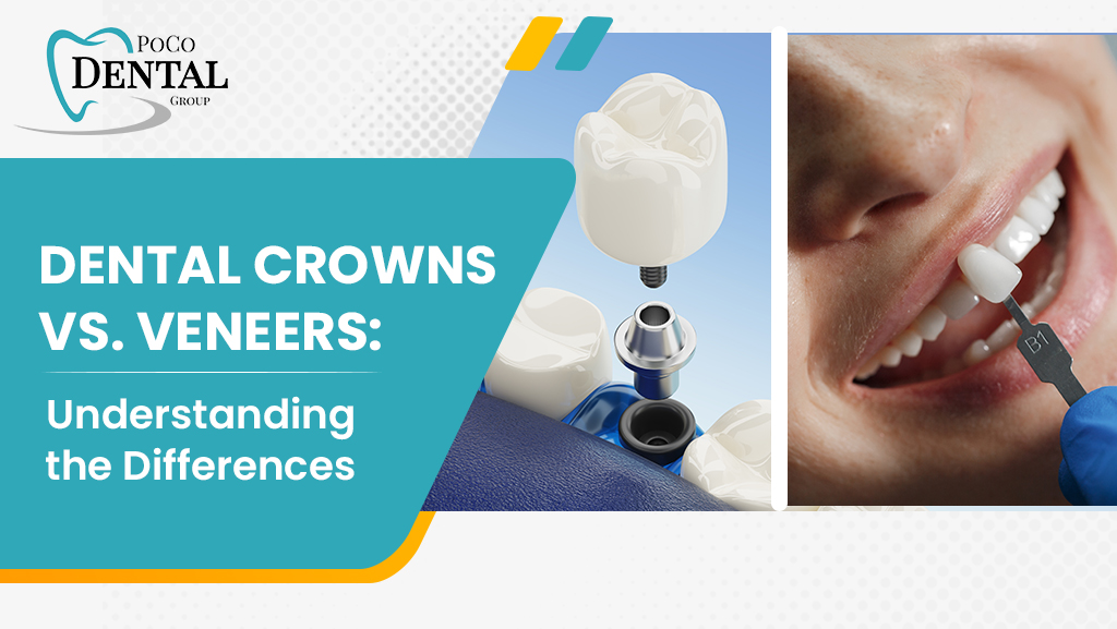 Dental Crowns vs. Veneers: Understanding the Differences