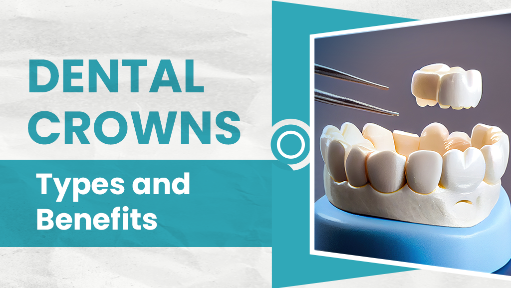 Dental Crowns: Types and Benefits