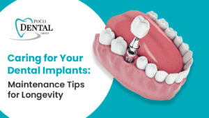 Caring for Your Dental Implants: Maintenance Tips for Longevity