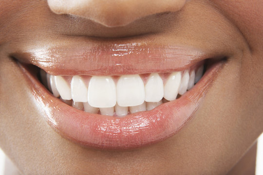 Teeth Whitening Maple Ridge