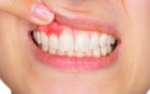 Gingivitis