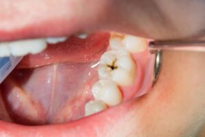 What Are Cavities? A Complete Guide to Tooth Decay and How to Prevent It