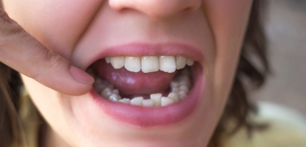 How Long Does It Take to Straighten Crooked Teeth?