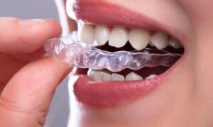 How Long Does Invisalign Treatment Take and What Affects It
