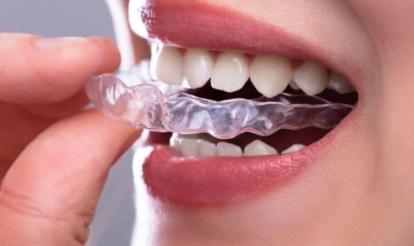 How Long Does Invisalign Treatment Take and What Affects It