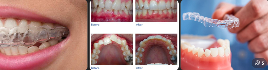 What Is Invisalign and How Does It Work