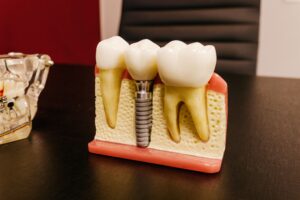 Are Dental Implants Safe