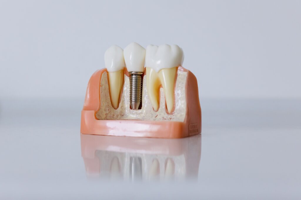 Benefits of Dental Implants