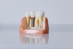 Benefits of Dental Implants