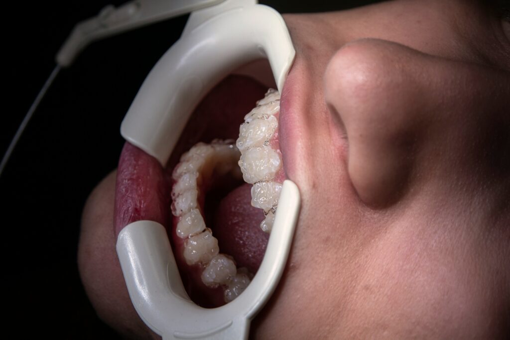 Cost of Dental Veneers in Port Coquitlam