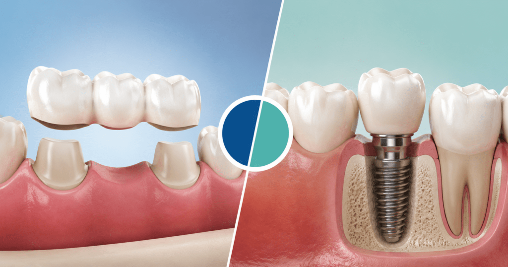 Dental Bridge vs. Dental Implant
