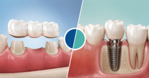 Dental Bridge vs. Dental Implant