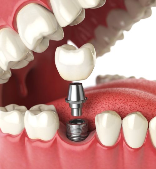 Dental Implants in Port Coquitlam