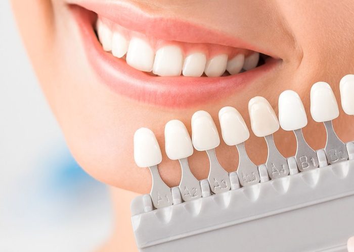 Porcelain Veneers Maple Ridge