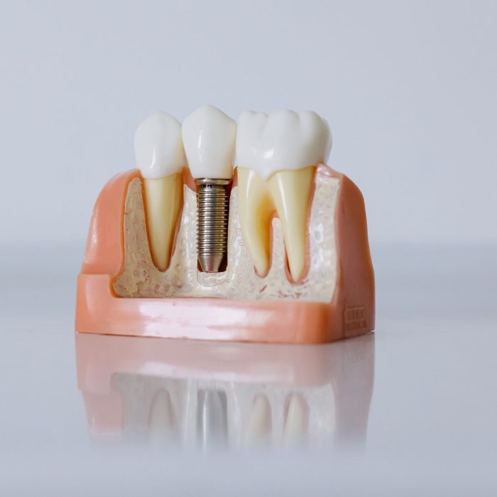 Benefits of Dental Implants